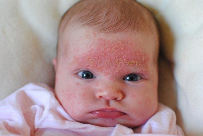 Акне у новорожденных на лице фото лечение