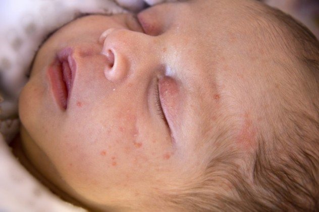 Акне у новорожденных на лице фото лечение