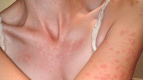 Allergic reaction to medications
