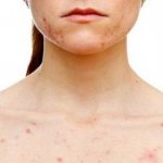 аллергическая сыпь на теле у взрослого
