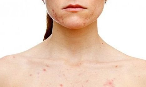 allergic rash on the body in an adult