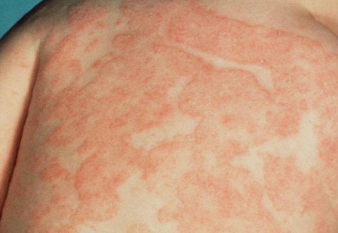 allergic spots