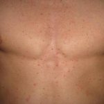 Аллергия на коже: красные пятна чешутся, лечение