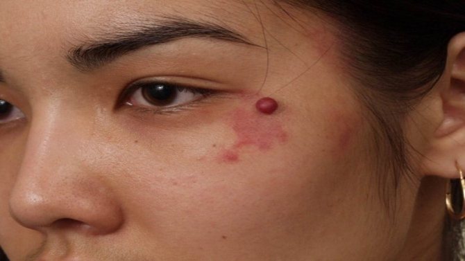 Skin angioma - photo in adults, treatment, symptoms, causes of development, laser removal