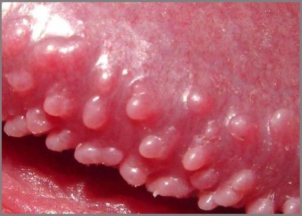 causes of white pimples on penis