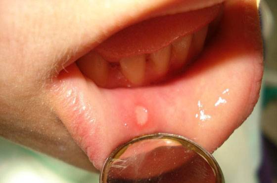 White dots on the lips under the skin: photos, causes, treatment