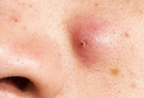 Painful acne on the face - the reason