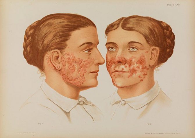 Warty tuberculosis