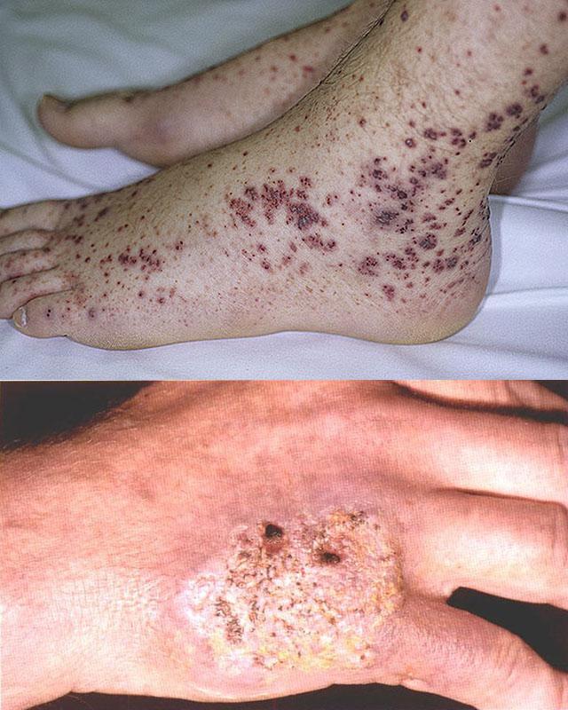 Warty skin tuberculosis