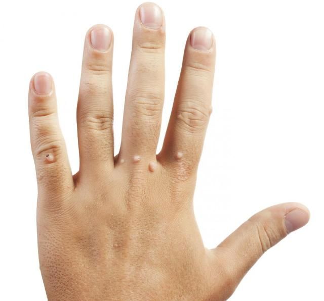 Бородавки на руках как показание к применению салициловой кислоты