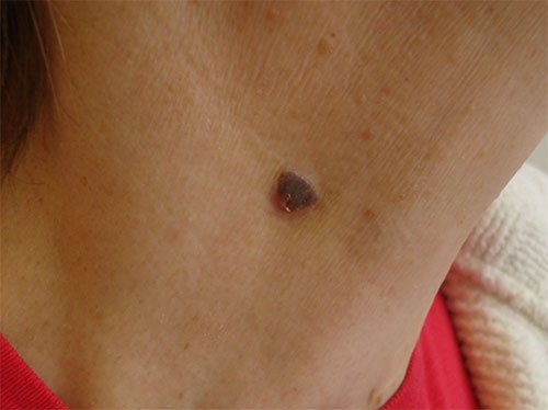 Why are warts on the neck dangerous?