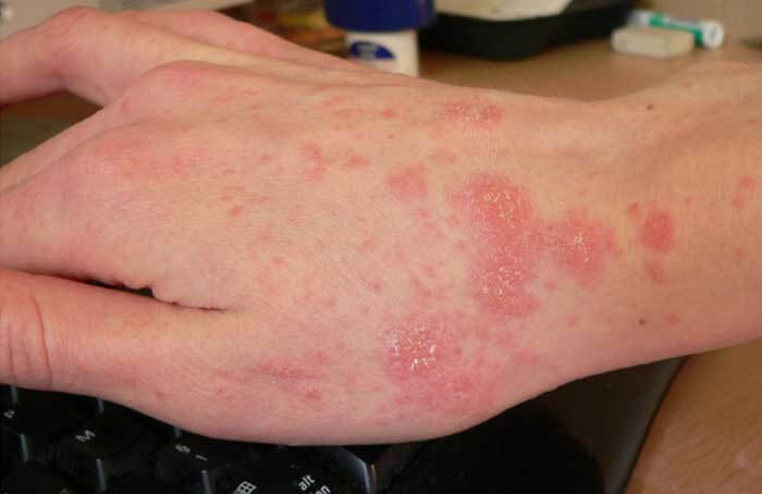 Scabies rashes