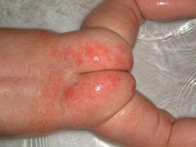 дерматит у ребенка