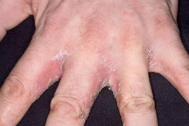 Dyshidrotic eczema - causes, symptoms and treatment