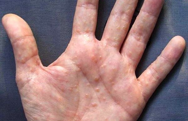 Dyshidrosis of the hands: causes, symptoms and treatment