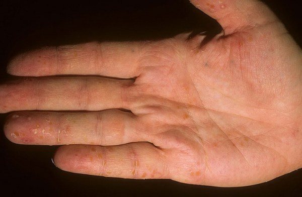 Дисгидроз кистей рук: причины, симптомы и лечение