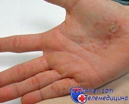 Dyshidrosis of the hands - symptoms and treatment methods