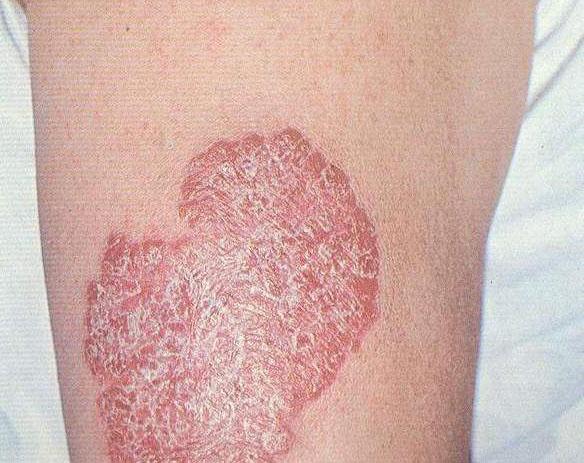 Exfoliative type of lupoid tuberculosis of the skin