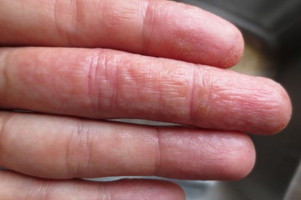 Dyshidrotic eczema, treatment of dyshidrosis of hands and feet