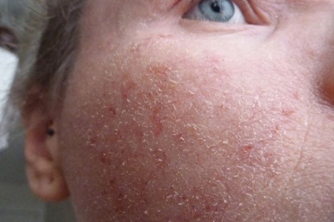 eczema on face photo