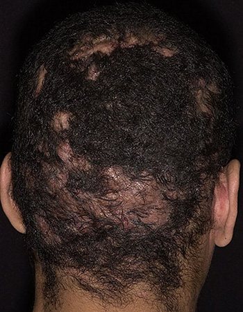 Фолликулит в тяжелых случаях приводит к потере волос и рубцам на пораженных участках