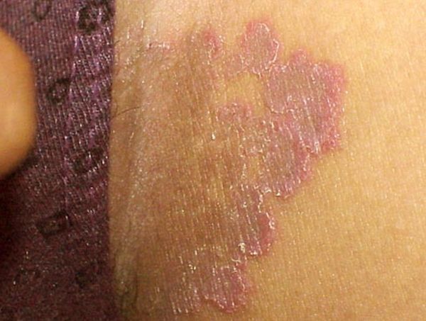 Photo 28 - After a boil in the groin, a scar is more likely to form
