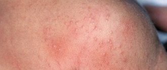 фото аллергического дерматита