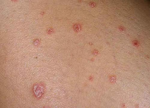 Photo of what psoriasis looks like at the initial stage