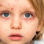 Герпес у детей – типы, симптомы и лечение самых частых типов вируса