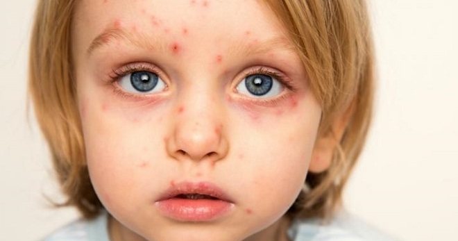 Herpes in children - types, symptoms and treatment of the most common types of virus