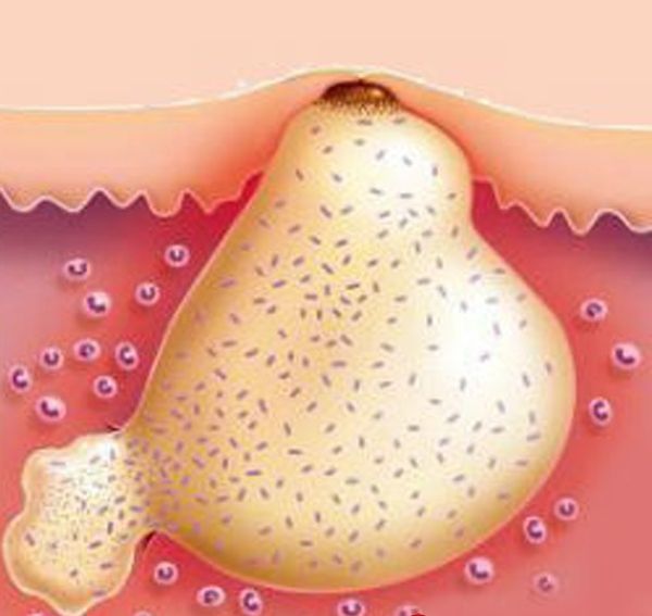 ulcers in the groin in women