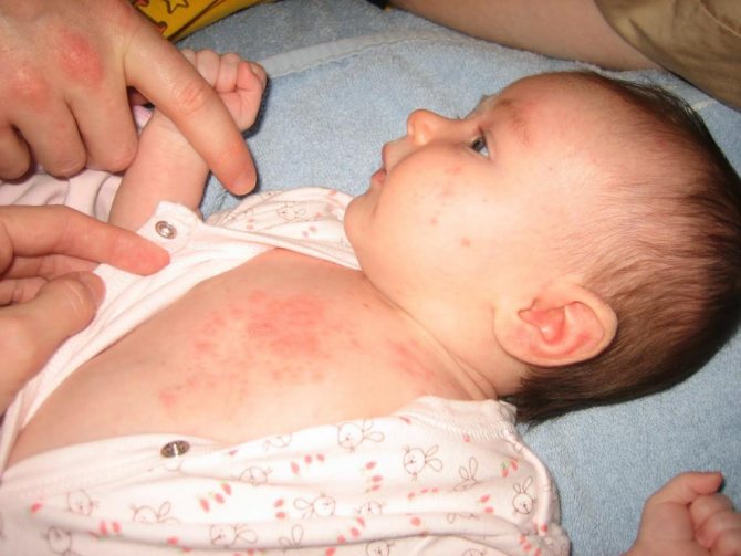 hormonal rash in infants photo