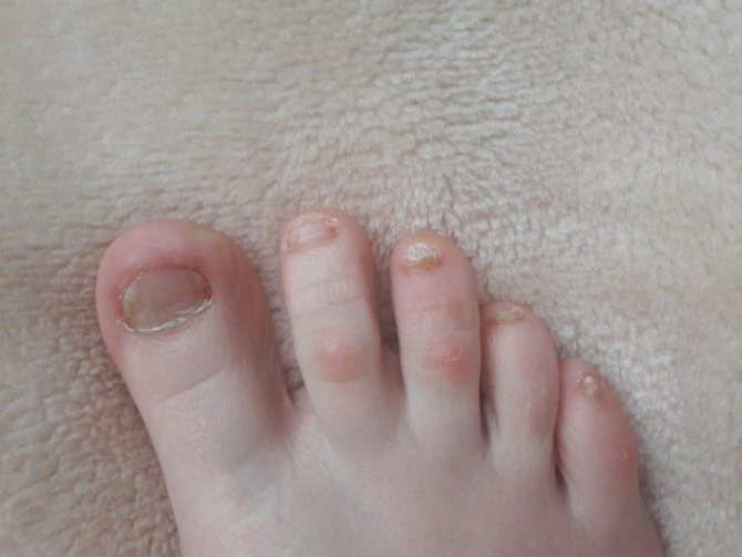 Fungus on the feet of children: photos and treatment