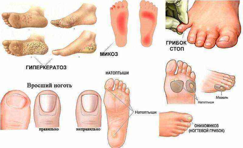 грибок на ногах у ребенка лечение народными средствами