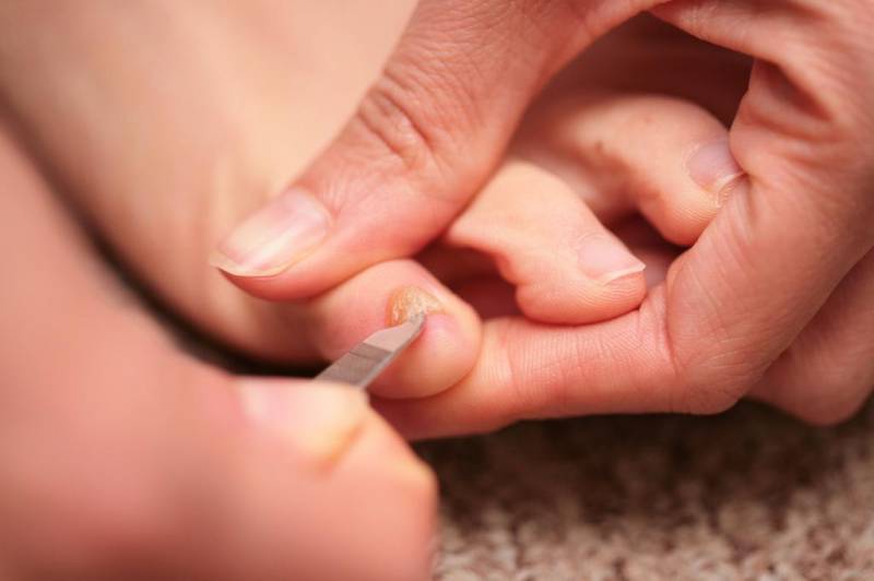 Грибок ногтей у детей: лечение, причины возникновения, симптомы с фото, необходимые анализы и назначение препаратов