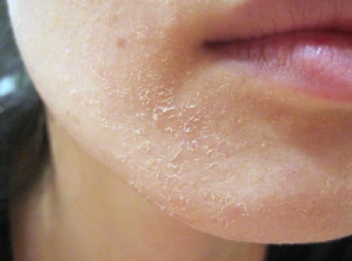 How to get rid of peeling on your face in one day. The main causes of severe peeling 