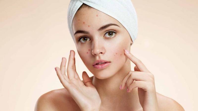 How to get rid of acne: causes, possible diseases, treatment methods, prevention