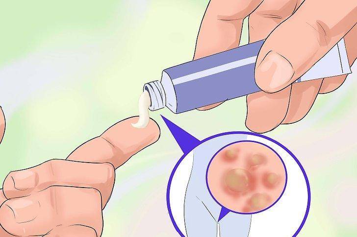 Как лечить папилломы во влагалище?