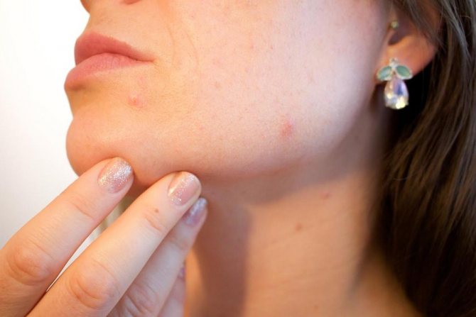 How to apply zinc ointment to acne