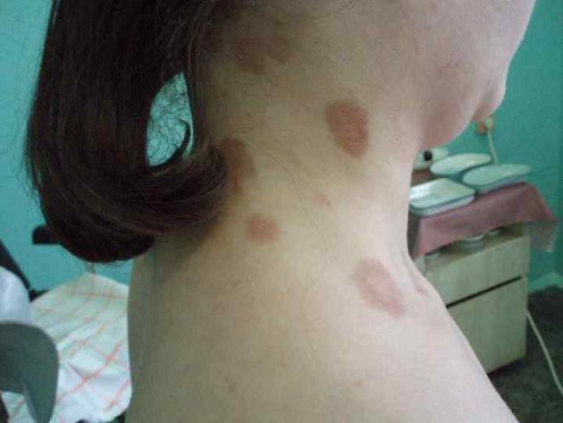 What do syphilis rashes look like, when and where do they appear?