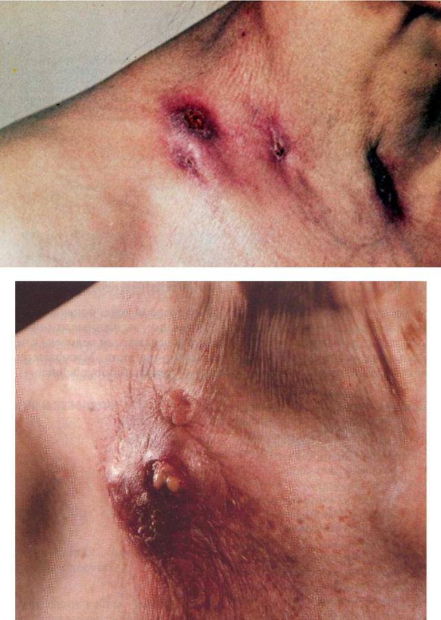 Collicative tuberculosis of the skin