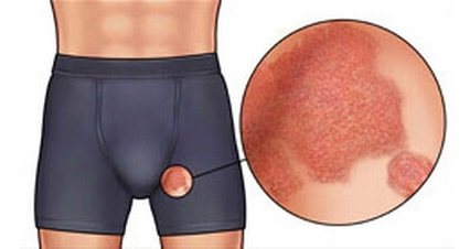 Red spot on the skin in the groin