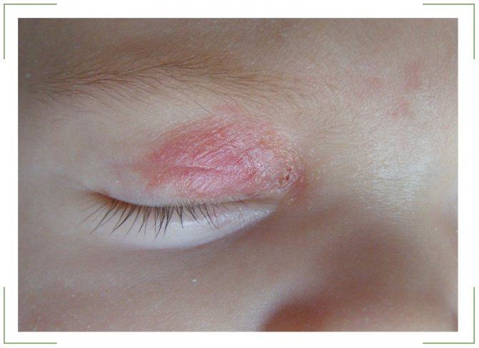 red spots on the eyelid