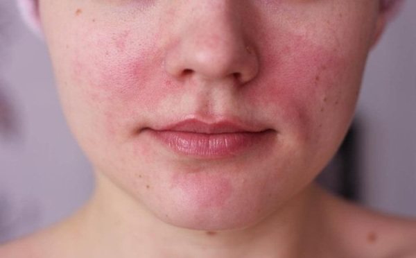 Red cheeks in an adult. Reasons why they burn, treatment, signs of illness 