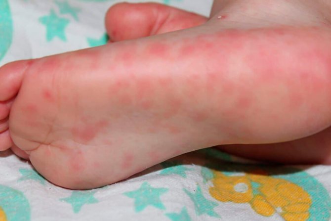 Red rashes on legs