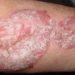 healing properties of tar soap for psoriasis