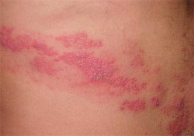 treatment of herpes zoster with traditional methods