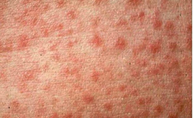 Maculopapular rashes: causes