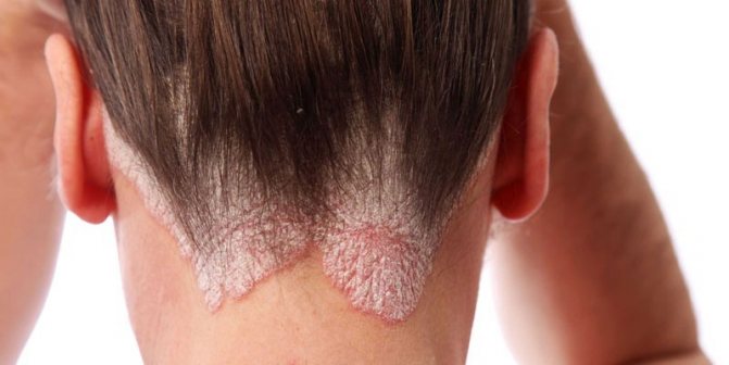 Mycosis on the back of a woman&#39;s head