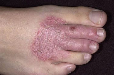 Microbial eczema on the foot.